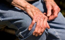 Hands effected by arthritis 